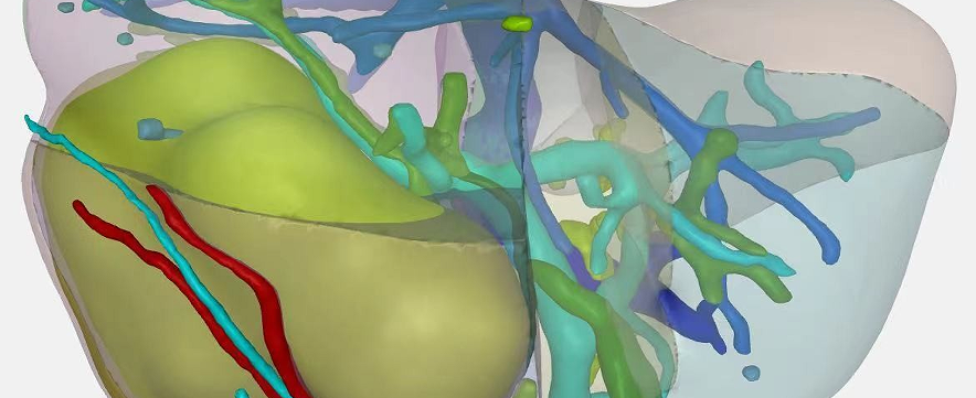 精准肝切除术治疗右肝巨大肝癌一例的启示