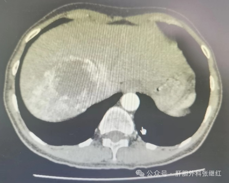 浅谈腹腔镜肝血管瘤切除术