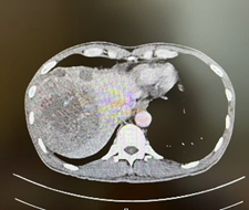 多发、巨大肝癌新辅助治疗后前入路右半肝切除1例