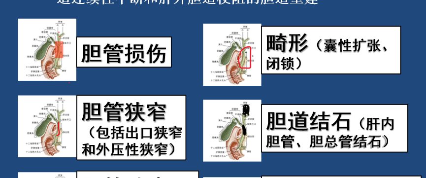 胆肠吻合的手术原理与应用要点