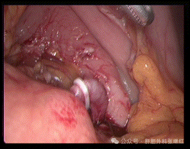 腹腔镜脾切除术安全吗？