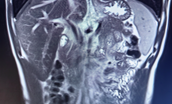 东莞台心医院肝胆胰外科特色技术（总览）