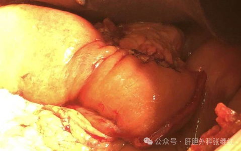 谈谈胰十二指肠切除术（一）