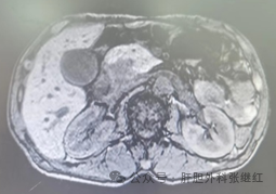 如何判断胰腺肿块的良恶性？