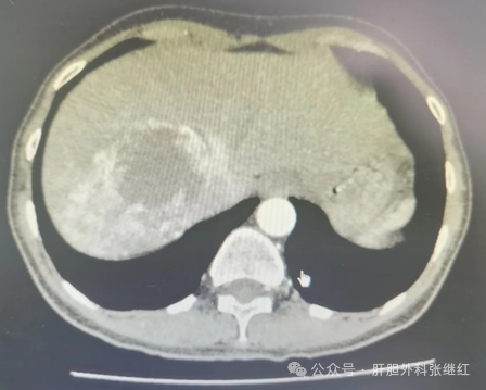 肝血管瘤患者当如何决策和抉择？