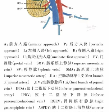 谈谈胰十二指肠切除术（三）