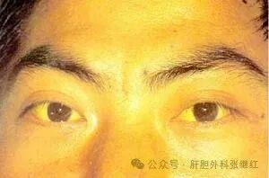 尿黄、眼黄、皮肤黄是怎么回事，怎么办？