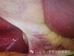 防止腹腔镜胆囊切除术中胆管损伤的手术原理