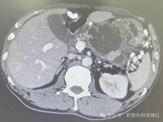 胰腺假性囊肿的治疗理念与技术
