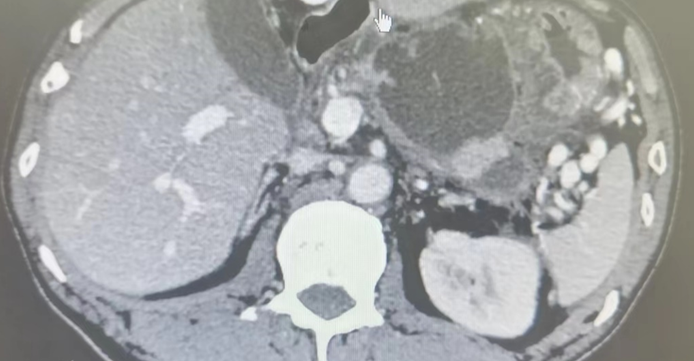 胰腺假性囊肿的治疗理念与技术