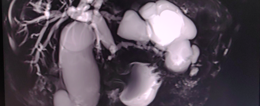 东莞台心医院肝胆胰外科特色技术（二）超声介入与放射介入诊疗技术