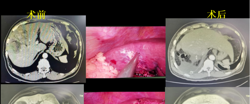 腹腔镜前入路肝切除术治疗右肝巨大肝癌
