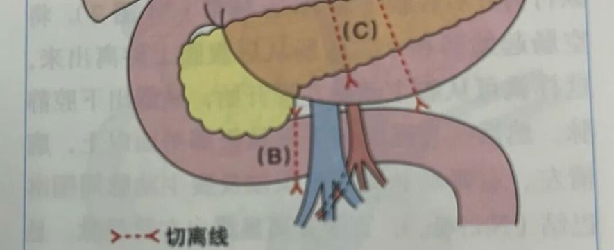 谈谈胰十二指肠切除术（二）