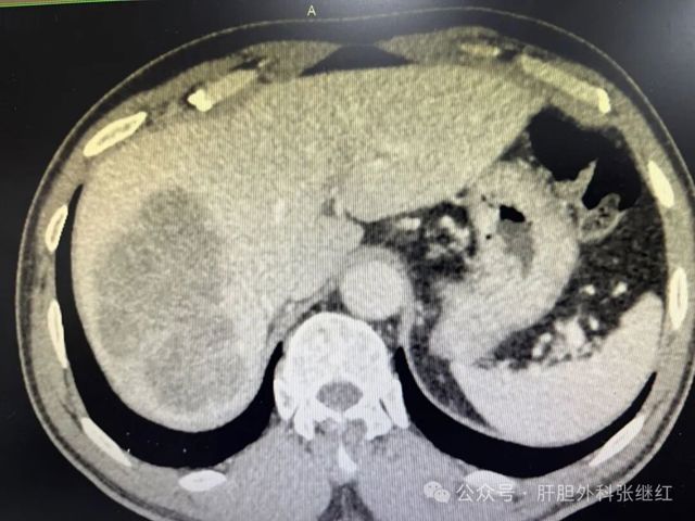 新辅助治疗后前入路右半肝切除术治疗右肝巨大肝癌