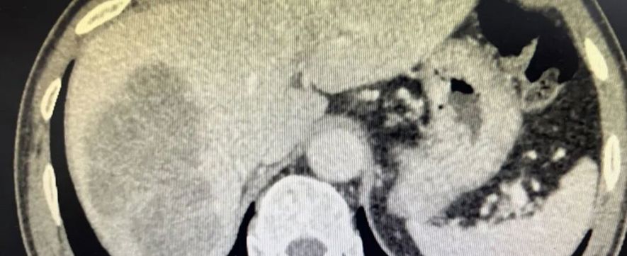 新辅助治疗后前入路右半肝切除术治疗右肝巨大肝癌