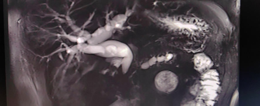 如何诊断和治疗胆管狭窄？